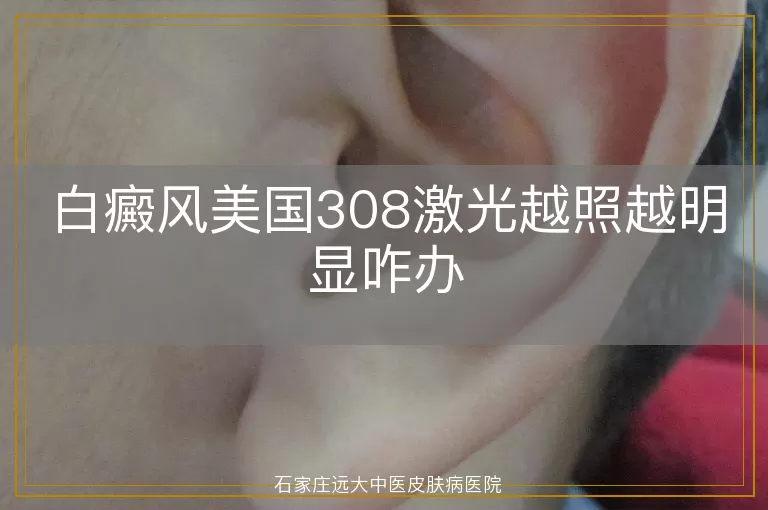 白癜风美国308激光越照越明显咋办