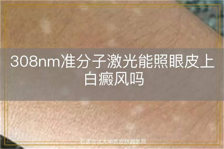 308nm准分子激光能照眼皮上白癜风吗