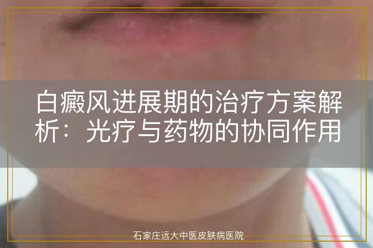 白癜风进展期的治疗方案解析:光疗与药物的协同作用