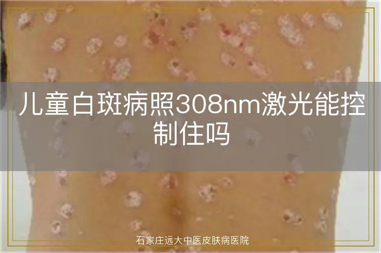 儿童白斑病照308nm激光能控制住吗