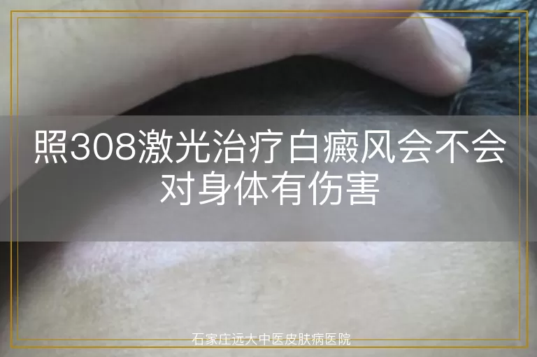 照308激光治疗白癜风会不会对身体有伤害
