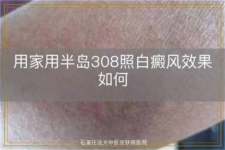 用家用半岛308照白癜风效果如何