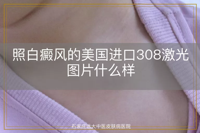 照白癜风的美国进口308激光图片什么样