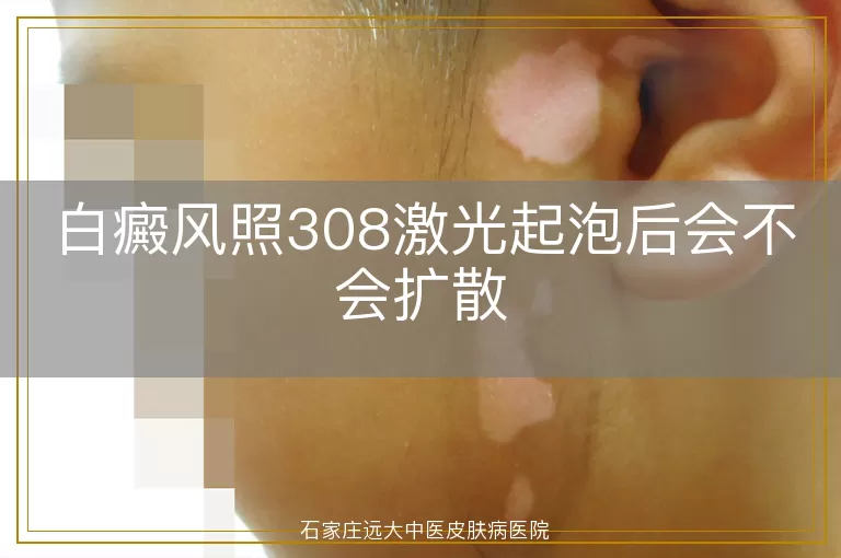 白癜风照308激光起泡后会不会扩散