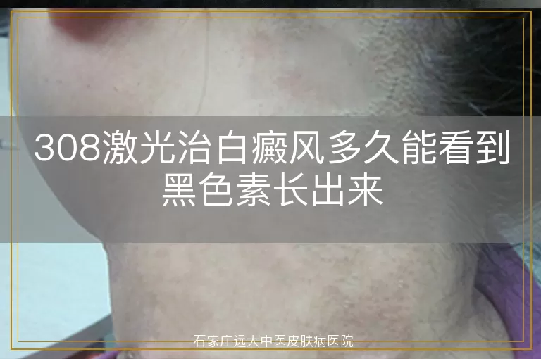 308激光治白癜风多久能看到黑色素长出来