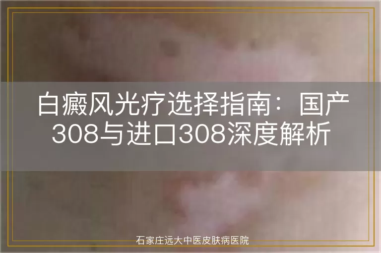 白癜风光疗选择指南:国产308与进口308深度解析