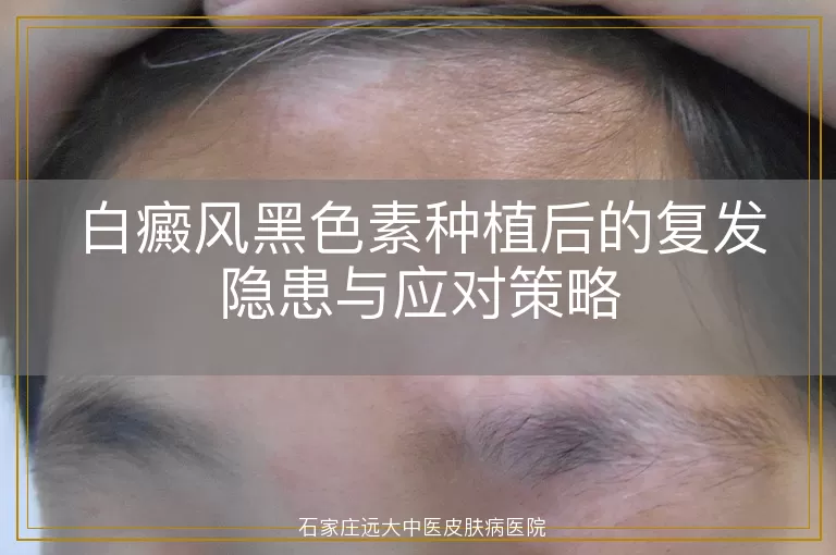 白癜风黑色素种植后的复发隐患与应对策略