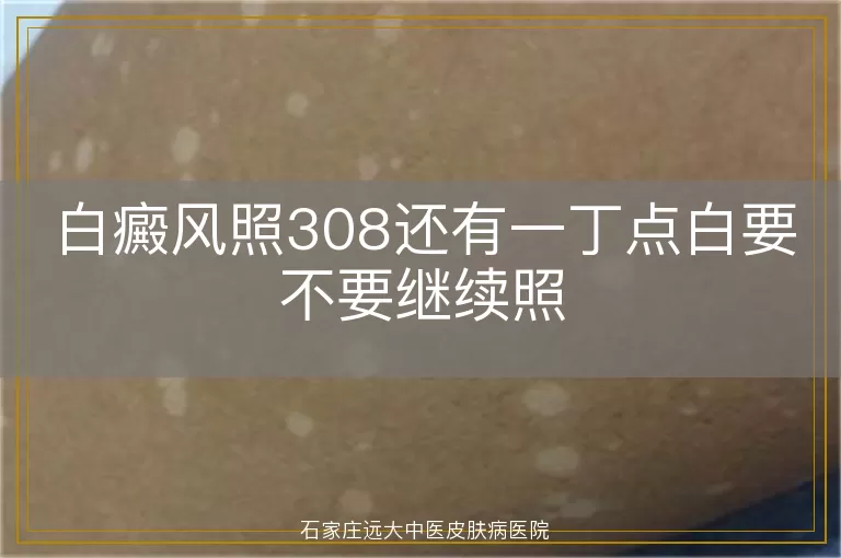 白癜风照308还有一丁点白要不要继续照