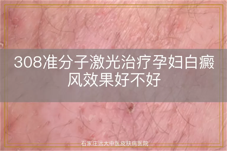308准分子激光治疗孕妇白癜风效果好不好