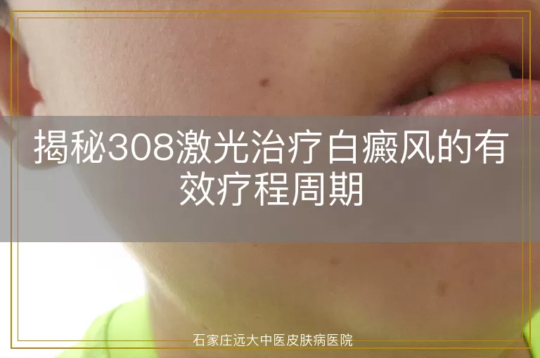 揭秘308激光治疗白癜风的有效疗程周期
