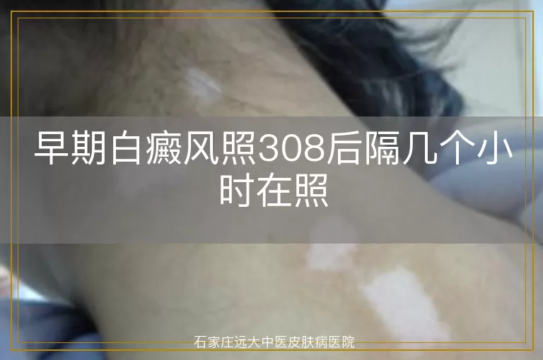 早期白癜风照308后隔几个小时在照