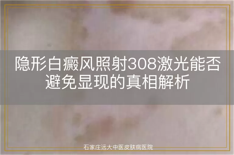 隐形白癜风照射308激光能否避免显现的真相解析