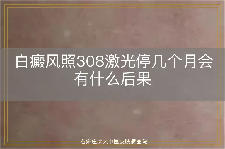 白癜风照308激光停几个月会有什么后果