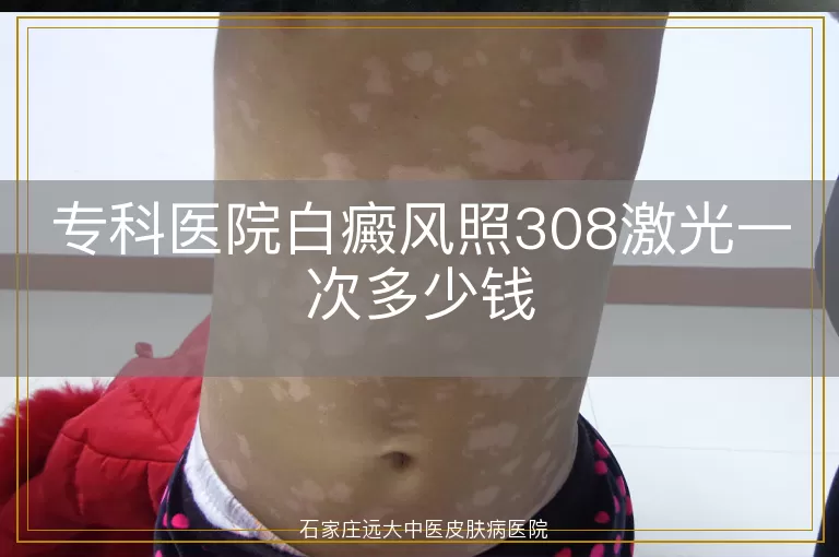 专科医院白癜风照308激光一次多少钱