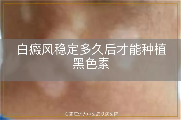 白癜风稳定多久后才能种植黑色素
