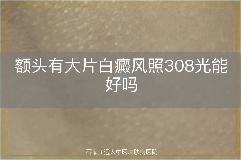 额头有大片白癜风照308光能好吗