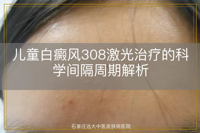 儿童白癜风308激光治疗的科学间隔周期解析