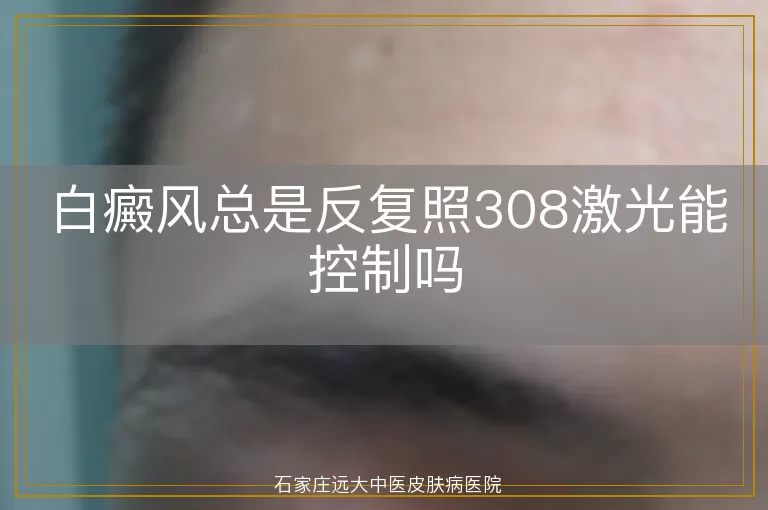 白癜风总是反复照308激光能控制吗
