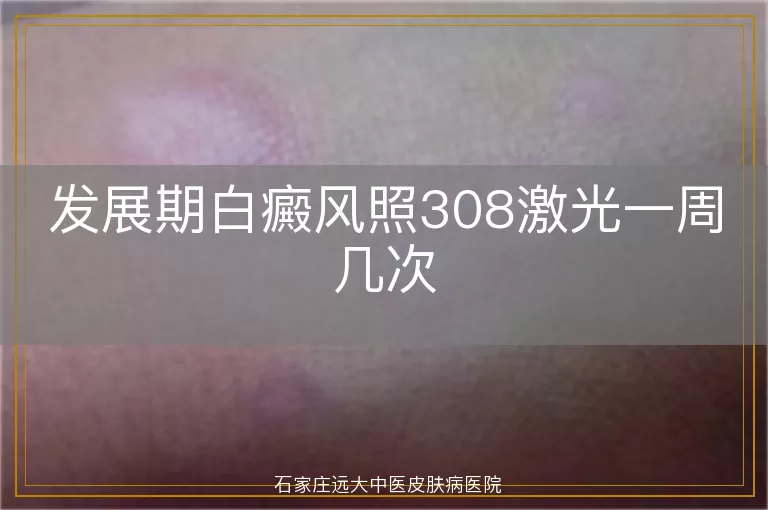 发展期白癜风照308激光一周几次