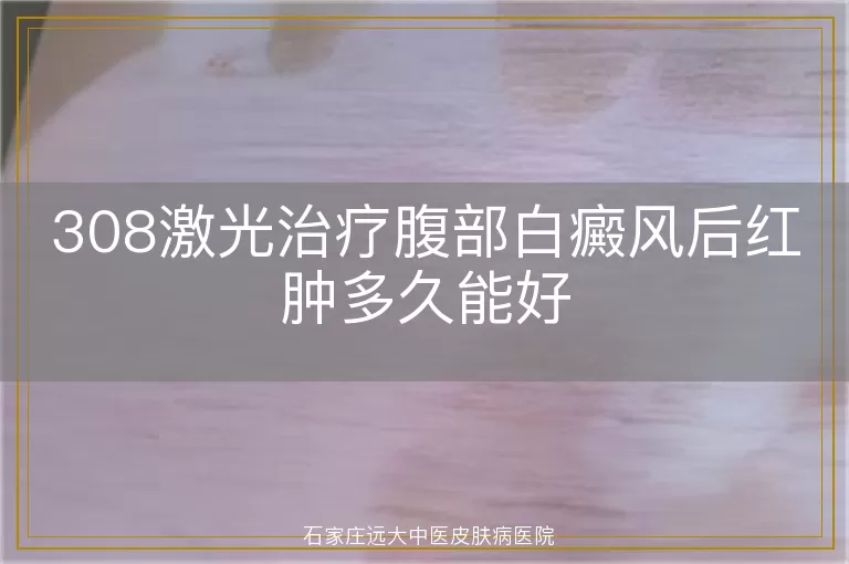 308激光治疗腹部白癜风后红肿多久能好