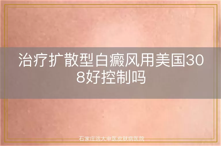 治疗扩散型白癜风用美国308好控制吗