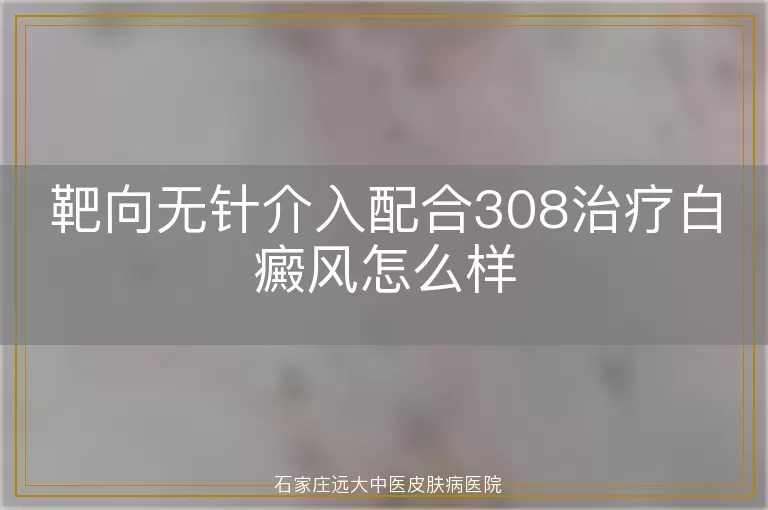 靶向无针介入配合308治疗白癜风怎么样