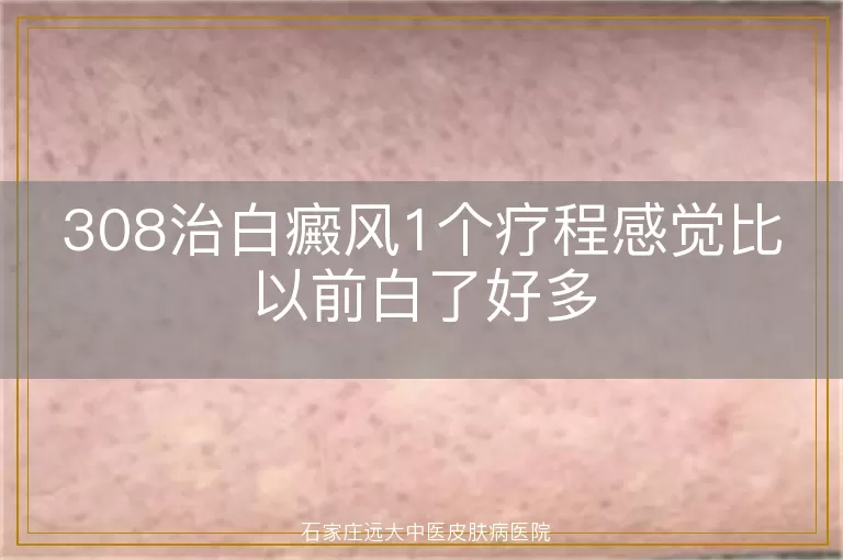 308治白癜风1个疗程感觉比以前白了好多