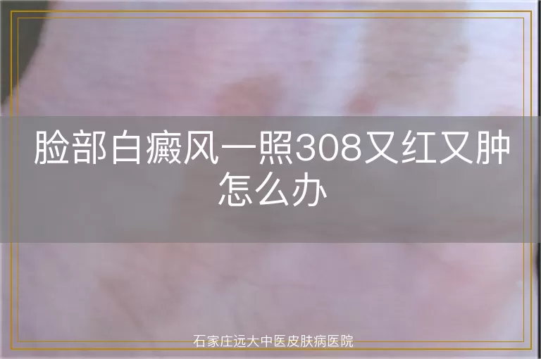 脸部白癜风一照308又红又肿怎么办