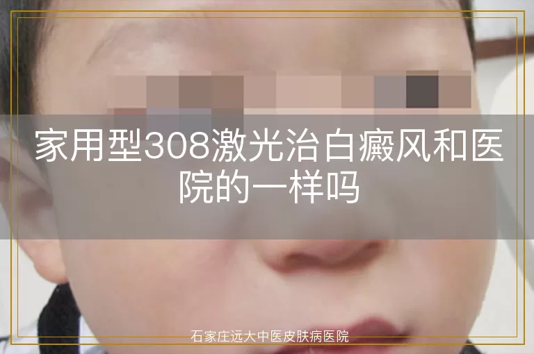家用型308激光治白癜风和医院的一样吗