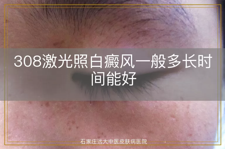 308激光照白癜风一般多长时间能好