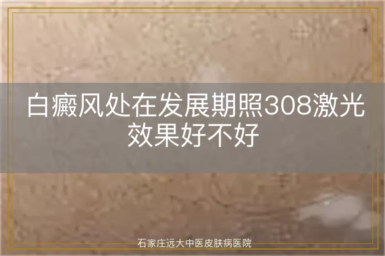 白癜风处在发展期照308激光效果好不好