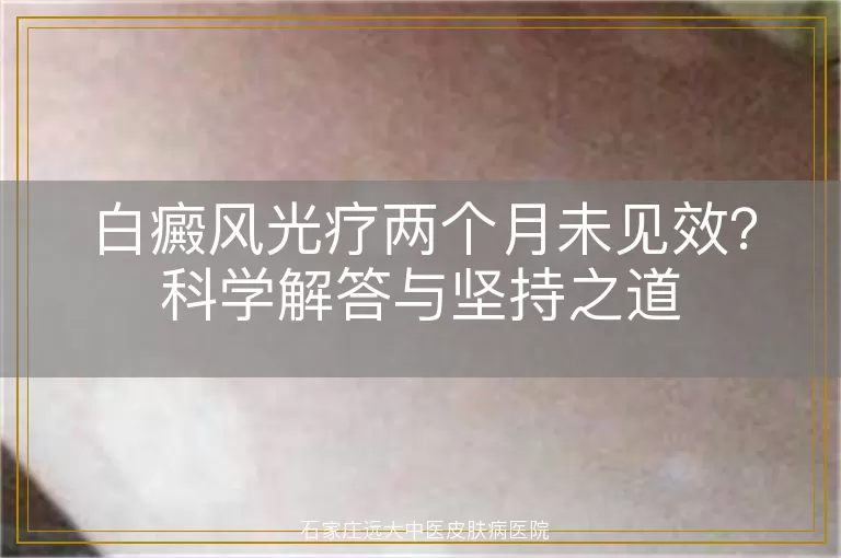 白癜风光疗两个月未见效？科学解答与坚持之道