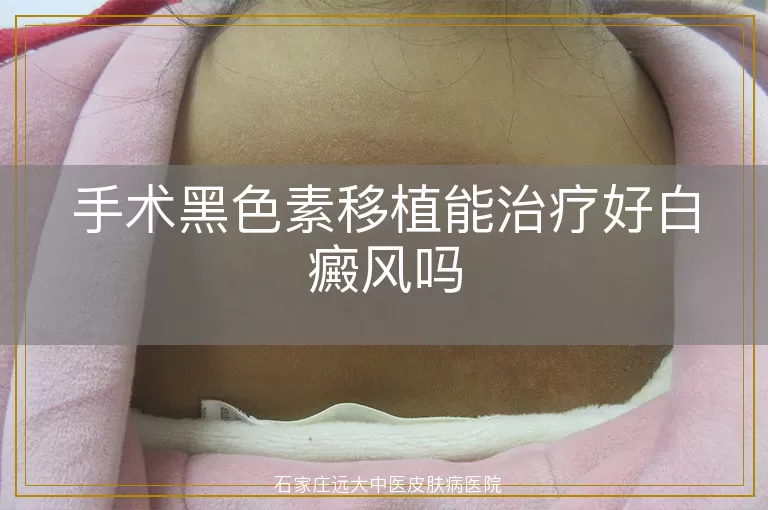 手术黑色素移植能治疗好白癜风吗