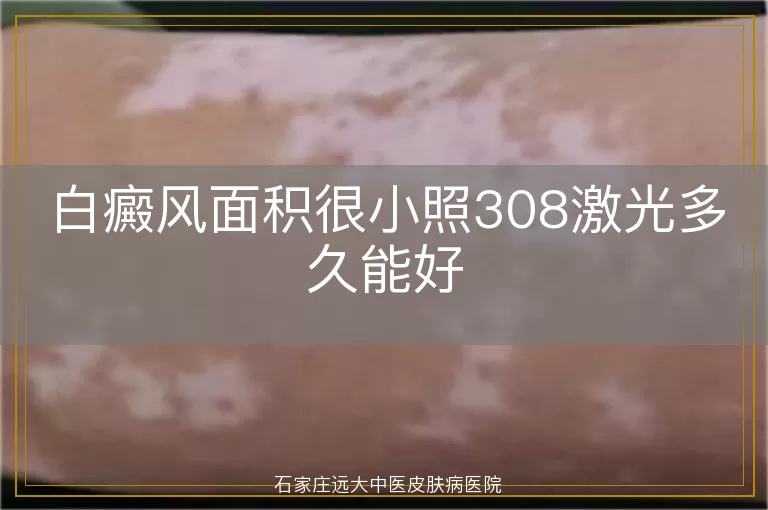 白癜风面积很小照308激光多久能好
