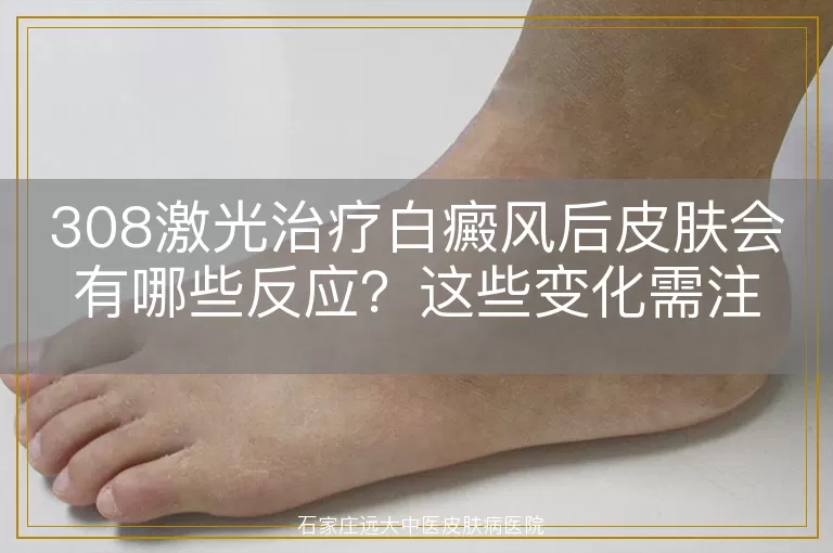 308激光治疗白癜风后皮肤会有哪些反应？这些变化需注意