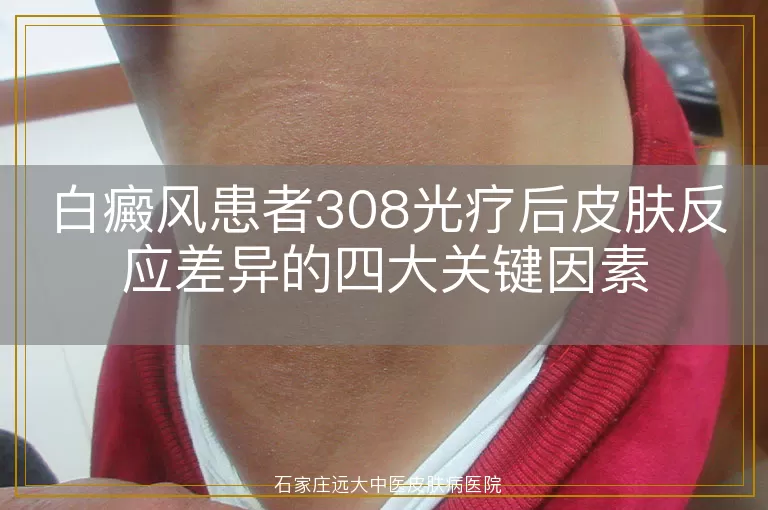 白癜风患者308光疗后皮肤反应差异的四大关键因素