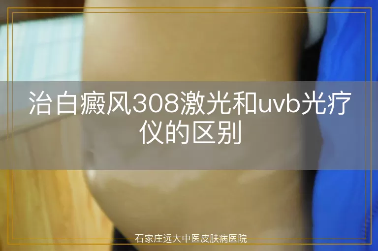 治白癜风308激光和uvb光疗仪的区别