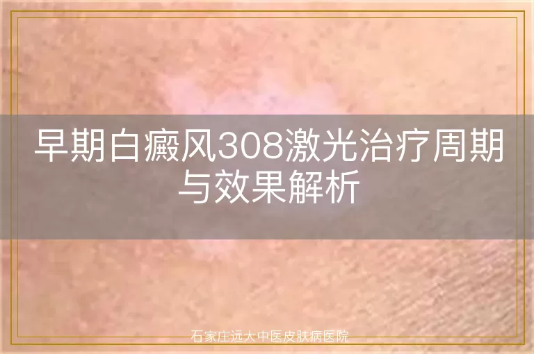 早期白癜风308激光治疗周期与效果解析