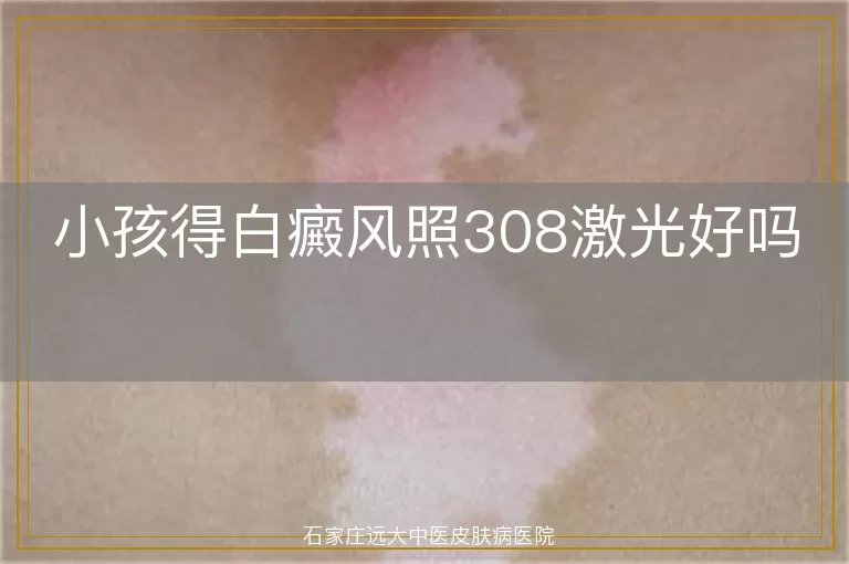 小孩得白癜风照308激光好吗