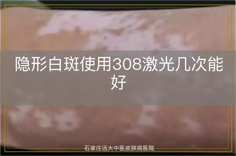 隐形白斑使用308激光几次能好