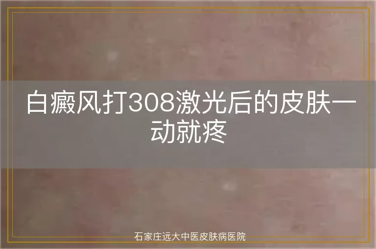 白癜风打308激光后的皮肤一动就疼