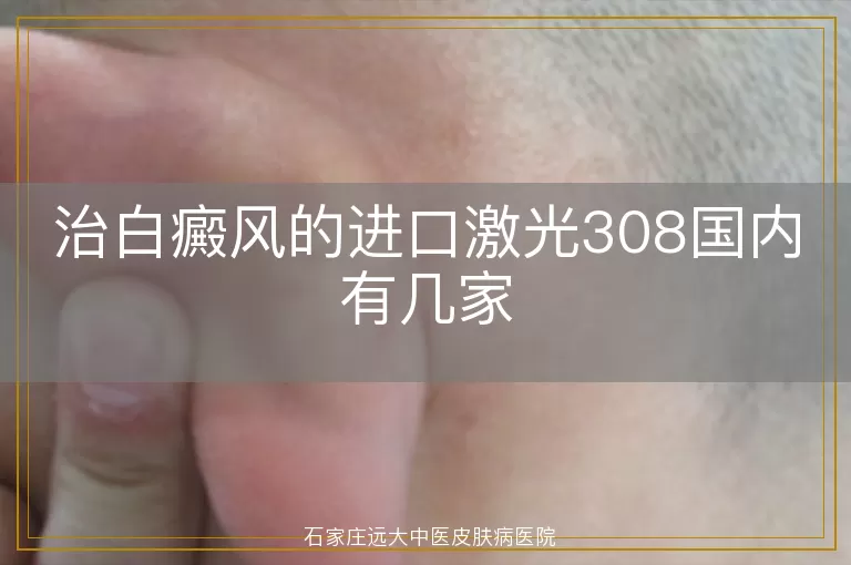 治白癜风的进口激光308国内有几家