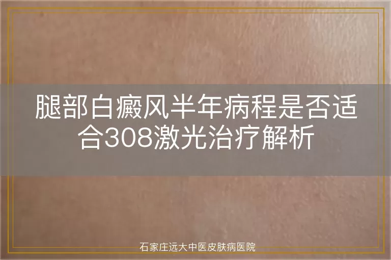 腿部白癜风半年病程是否适合308激光治疗解析