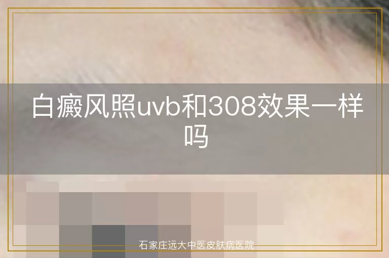 白癜风照uvb和308效果一样吗