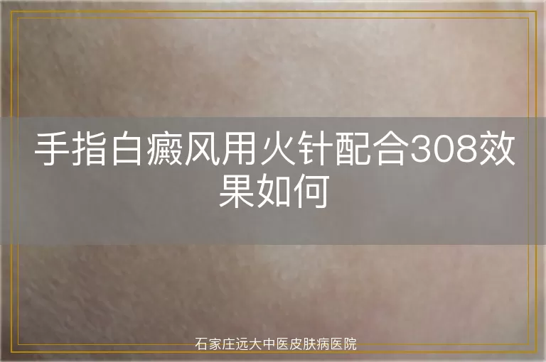 手指白癜风用火针配合308效果如何