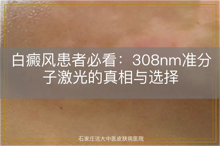 白癜风患者必看：308nm准分子激光的真相与选择