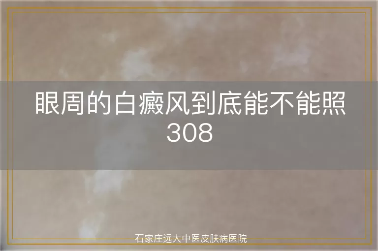 眼周的白癜风到底能不能照308