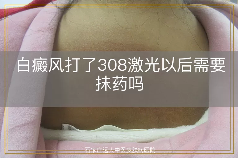 白癜风打了308激光以后需要抹药吗