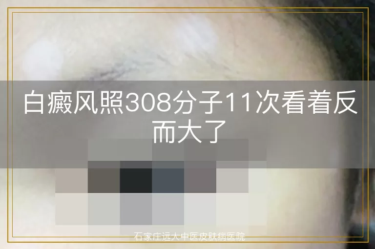 白癜风照308分子11次看着反而大了