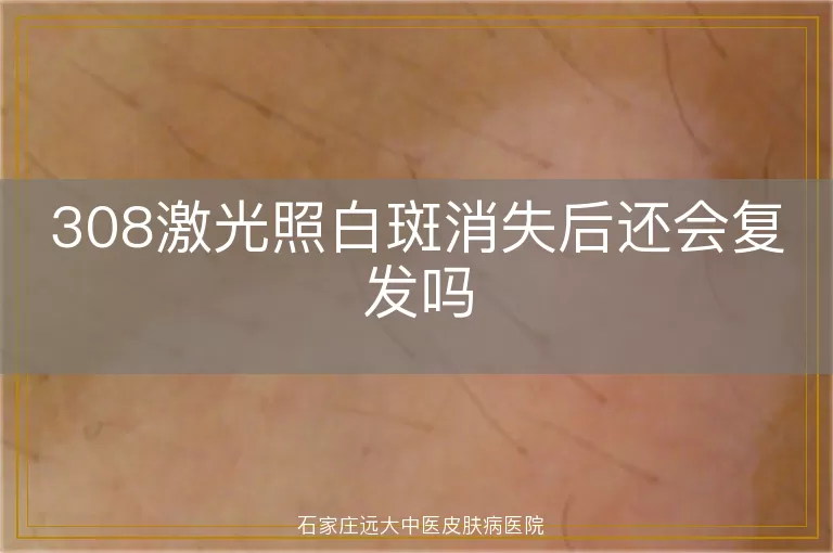 308激光照白斑消失后还会复发吗
